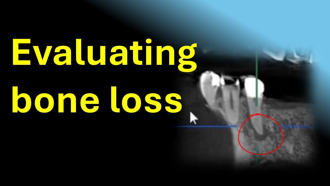 Using a dental cone beam to assist in identifying bone loss