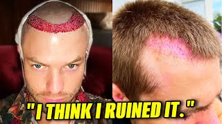 10 Things I Wish I Knew Before Getting a Hair Transplant