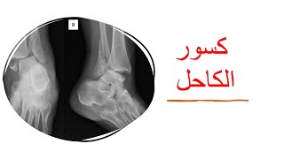 Ankle fracture / كسور الكاحل والأكعاب وعلاجها وتمزق أربطة الكاحل