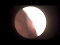 비중격 천공 수술 전 후(pre-&amp; postoperative result, repair of septal perforation)