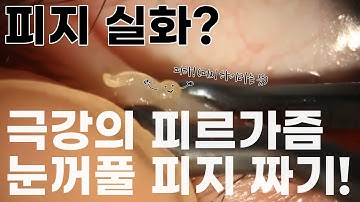 안과 피지 압출 클라쓰! 눈꺼풀 피지 짜기