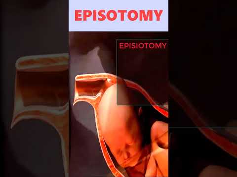 Video: Ar epiziotomijos siūlės yra b altos?