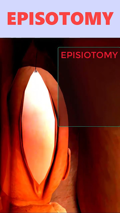 Episiotomy Surgical Incision 🙅👙 #shorts #labor