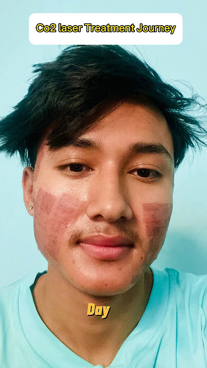 Co2 laser Treatment Journey || Acne Scar,Cut Mark Solution #laser #acnescars