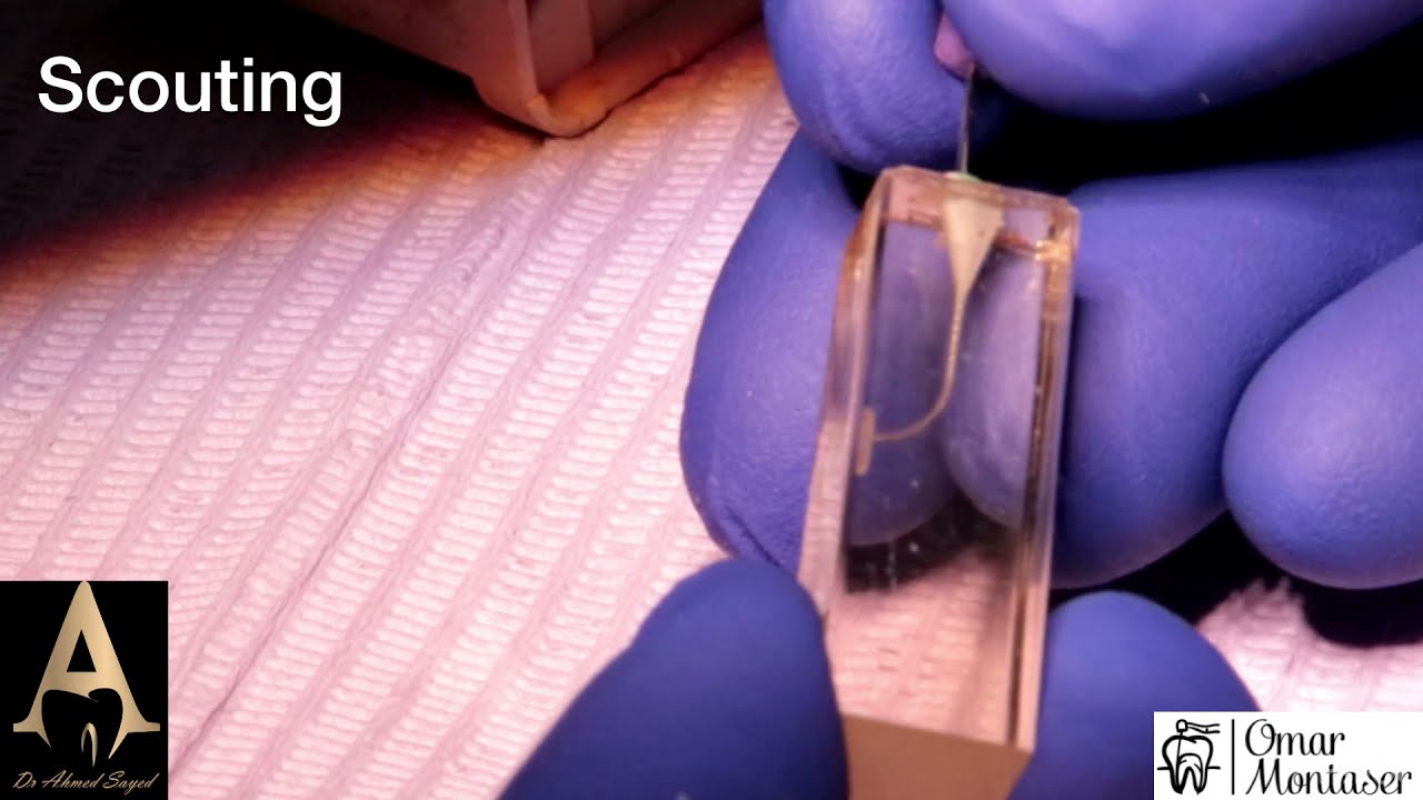 Shaping a severely curved canal: step-by-step