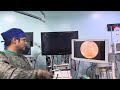 Watch Me Open a Urethral Stricture Endoscopically – Zero External Incision !