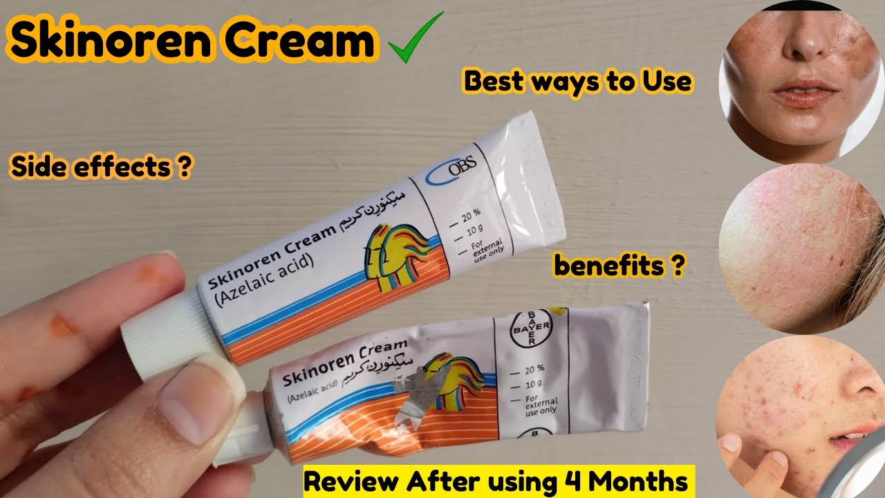 Skinoren Cream Uses & Side effects | How to get rid of Acne , Acne Scars, Hyperpigmentation | Part 1