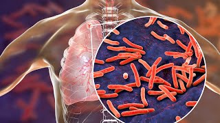 CCSD, SNHD investigating after tuberculosis case was diagnosed