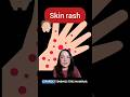 Medical Spanish: how to say ‘skin rash’ #spanishlesson #learnspanish #spanishteacher