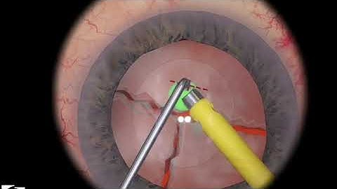 EyeSi CAT C Phaco Chopping Training, Level 5 (Two Half Nuclei, Vertical Chopper)