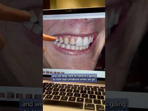 How many teeth do we include when doing bonding or veneers?