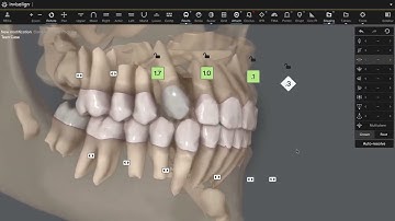 Invisalign CBCT integration for Clincheck Software