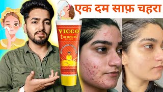 Vicco Turmeric Cream Review | Vicco Turmeric Cream Benifits on Acne, Pimples, Dark Spots