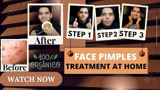 Face Pimples Treatment At Home | ACNE TREATMENT | Pimples Kese Hataye |  #shivammalik