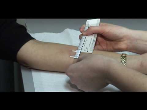 TB Skin Test - Mantoux Method