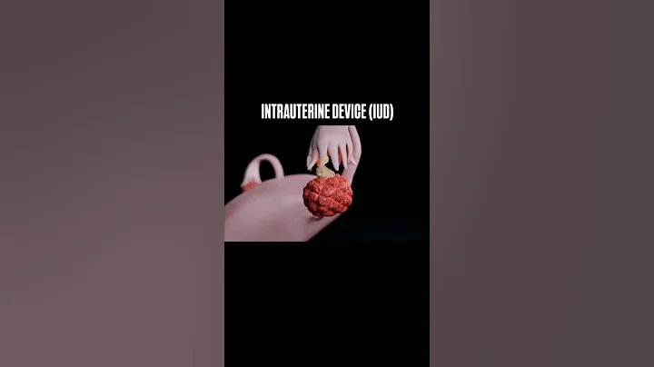 IUD implants in female body