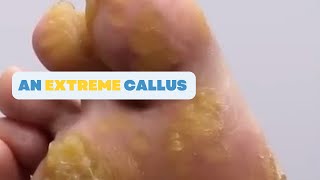WHAT CAUSES AN EXTREME CALLUS LIKE THIS?!