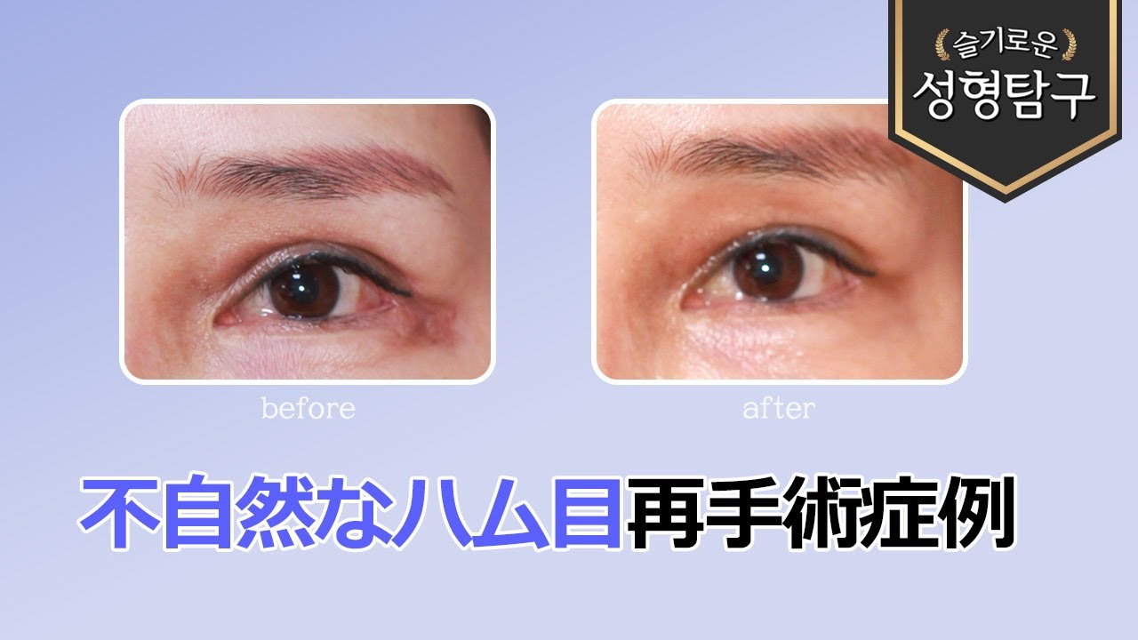 【韓国二重修正】不自然な目頭とハム目再手術症例