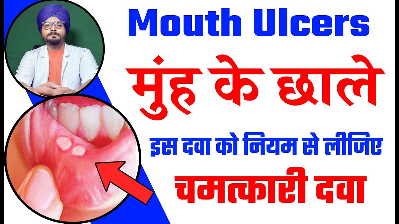 Homeopathy Medicine For Mouth Ulcer Muh Me Chale Ki Homeopathic