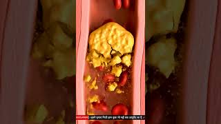 Ayurvedic Remedy for High Cholesterol | How to Reduce Cholesterol Naturally | Kadha For Heart Health