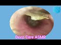 ASMR Ear Cleaning | Guaranteed Tingles and Instant Relaxation