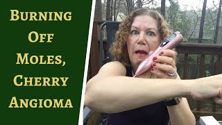The GOOD, BAD and UGLY About Cherry Angioma Removal Zapping Myself with this AMAZON TOOL