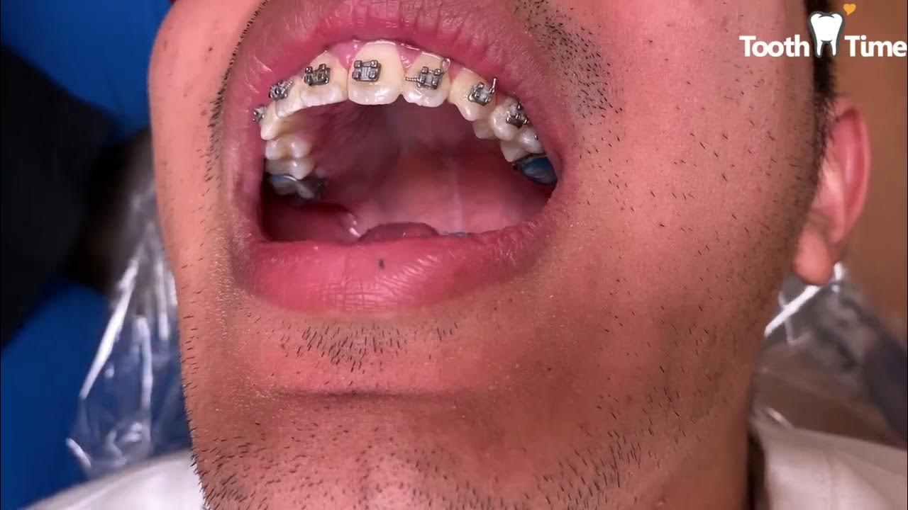 Loose Molar Band Braces Emergency Tooth Time Family Dentistry New