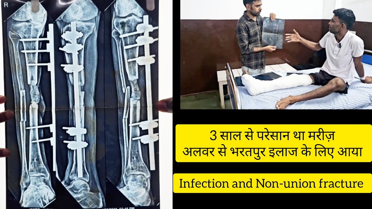 Перелом большеберцовой кости, инфекция, несращение костей. Пациент прибыл из Алвара, Раджастхан. ...