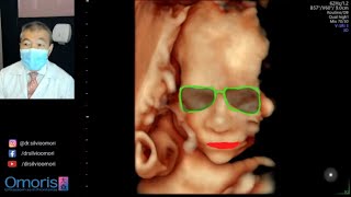 Gestação de 22 semanas com uma VARIAÇÃO ANATÔMICA no cordão umbilical.