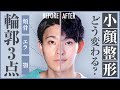 小顔になりたい！頬骨・エラ・オトガイ（顎）の輪郭3点骨切りのビフォーアフターと手術法を詳しく解説。実際にどの位小さくなる？【リッツ美容外科】