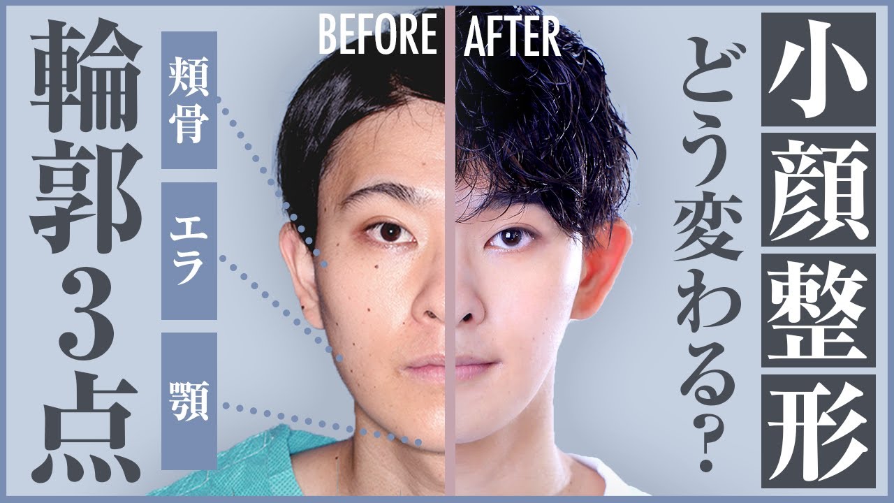 I Want a Smaller Face! A Detailed Guide to 3-Point Facial