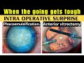 When the going gets tough intraoperative surprise  phacoemulsification  anterior vitrectomy