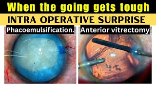 When The Going Gets Tough Intraoperative Surprise - Phacoemulsification Anterior Vitrectomy