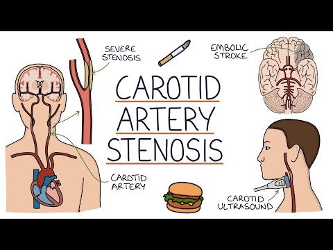 Understanding Carotid Artery Stenosis