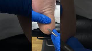 Expert Heel Corn and Callus Removal by Australian Podiatrist | Effective Solutions with Ergonx