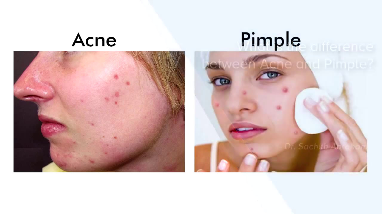 Difference Between Acne And Pimple| Best Skin Clinic In Bangalore ...