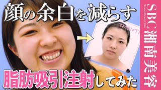 垢抜け小顔変身 頬アゴ肉を注射で取った結果 だいぶいけた 小顔用 脂肪吸引注射と糸リフトで美女化促進整形 湘南美容クリニック Youtube