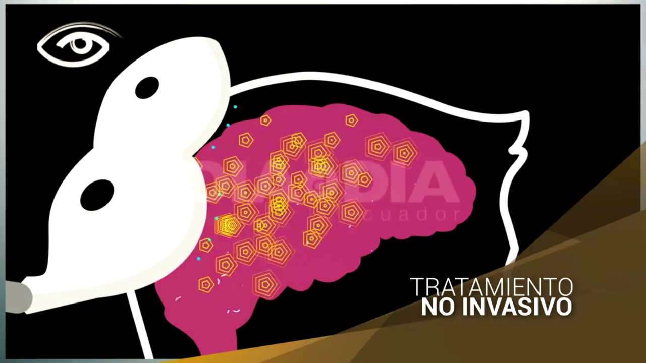Estimulación Magnética Transcraneal EMT en Ecuador digital marketing