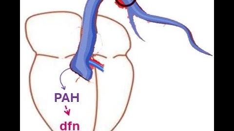 PAH Treatment_Snippet Overview_Dr Pradeep Rangappa