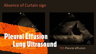 Pleural Effusion Lung Ultrasound. Perioperative & Critical Care POCUS