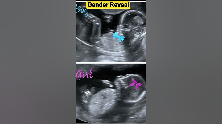 Findout Your Baby’s Gender At the Ultrasound Scan👶🏻Baby Gender Reveal #shorts#short#trending#baby