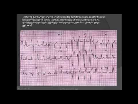 ეკგ/ აორტული სარქვლის სტენოზი (აორტული სტენოზი, აორტული მანკი, აორტის სარქვლის სტენოზი)