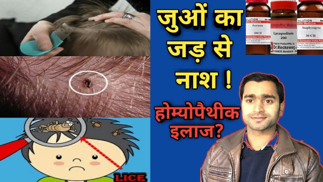 Lice ! Homeopathic medicine for lice ! Homeopathic Anti Lice Medicine