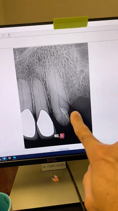 #dentists #dentalartistry #dentaltreatment #hygienist #rootcanaltherapy #apexdental #dentalclinic