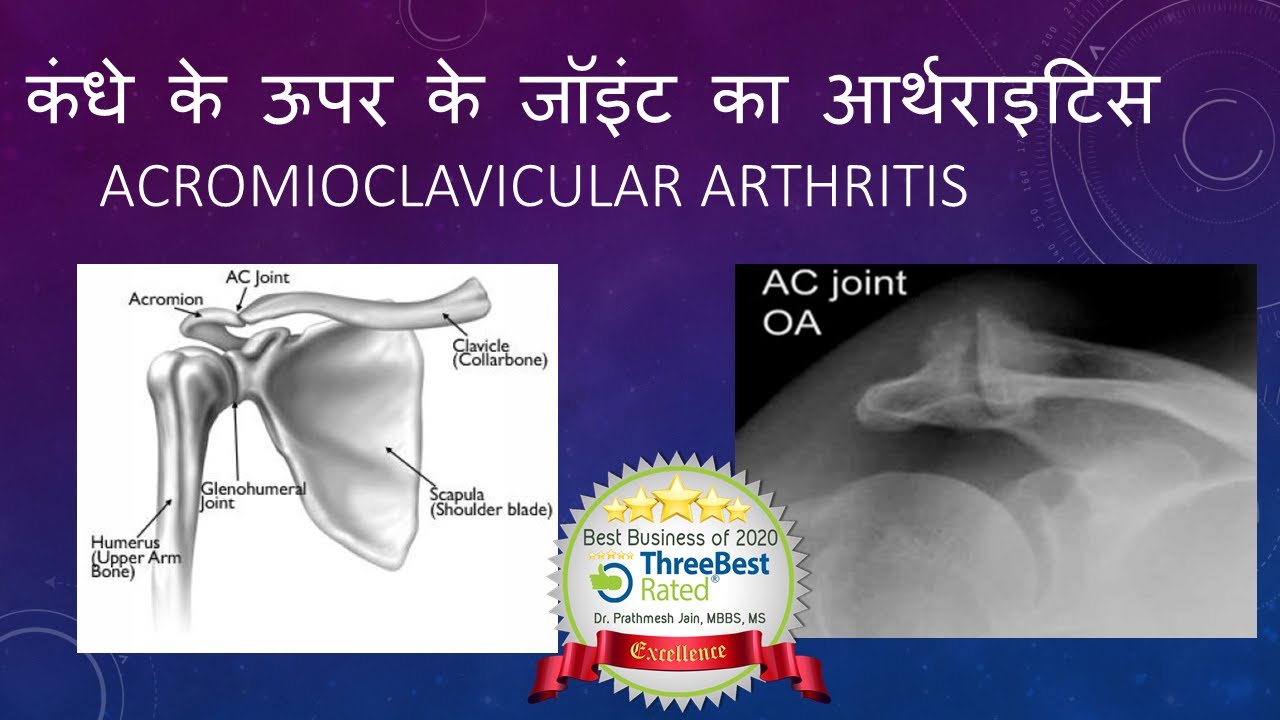 Osteoarthrosis acromioclavicularis Clavicularis-acromialis ízületi arthrosis