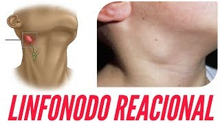 Feminina coxa glândulas inchadas