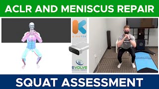 Anterior Cruciate Ligament Reconstruction And Meniscus Repair | Squat Assessment
