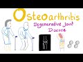 Osteoarthritis (OA) Part 1: Introduction