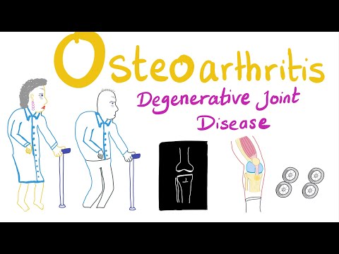 Videó: Boka Osteoarthritis