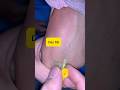 How to Insert a 24G Yellow IV Cannula on Hand Veins Perfectly! | Day 68#shorts #viral #safai#safi